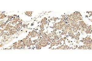 Immunohistochemistry of paraffin-embedded Human lung cancer tissue using GPR139 Polyclonal Antibody at dilution of 1:50(x200) (GPR139 Antikörper)