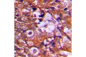 Immunohistochemical analysis of PTEN staining in human prostate cancer formalin fixed paraffin embedded tissue section. (PTEN Antikörper  (C-Term))