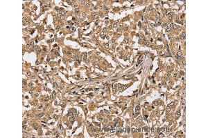 Immunohistochemistry of Human liver cancer using PPP1CC Polyclonal Antibody at dilution of 1:40 (PPP1CC Antikörper)