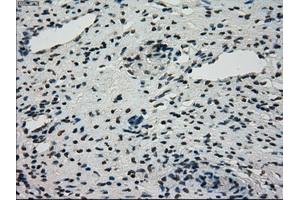 Immunohistochemical staining of paraffin-embedded Adenocarcinoma of breast tissue using anti-STK39 mouse monoclonal antibody. (STK39 Antikörper)