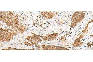 Immunohistochemistry of paraffin-embedded Human esophagus cancer tissue using NUP58 Polyclonal Antibody at dilution of 1:50(x200) (NUPL1 Antikörper)