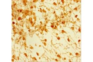 Immunohistochemistry of paraffin-embedded human melanoma using ABIN7160242 at dilution of 1:100