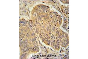 PSMD7 Antibody immunohistochemistry analysis in formalin fixed and paraffin embedded human lung carcinoma followed by peroxidase conjugation of the secondary antibody and DAB staining. (PSMD7 Antikörper  (C-Term))