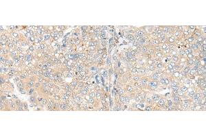 Immunohistochemistry of paraffin-embedded Human liver cancer tissue using CAMK2A Polyclonal Antibody at dilution of 1:55(x200) (CAMK2A Antikörper)
