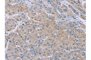 The image on the left is immunohistochemistry of paraffin-embedded Human liver cancer tissue using ABIN7192258(SAMD4B Antibody) at dilution 1/20, on the right is treated with synthetic peptide.