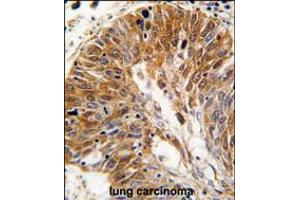 Formalin-fixed and paraffin-embedded human lung carcinoma tissue reacted with PSMD11 antibody , which was peroxidase-conjugated to the secondary antibody, followed by DAB staining. (PSMD11 Antikörper  (C-Term))