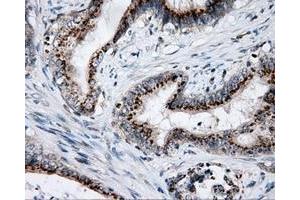 Immunohistochemical staining of paraffin-embedded Adenocarcinoma of colon tissue using anti-LIPG mouse monoclonal antibody. (LIPG Antikörper)