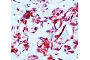 Formalin fixed paraffin embedded human angiosarcoma stained with Flt-1 antibody