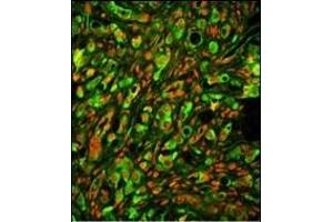 Immunofluorescence analysis of PTP4A2 Antibody (Center) with paraffin-embedded human prostate carcinoma tissue.