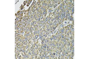 Immunohistochemistry of paraffin-embedded human liver cancer using RASSF1 antibody (ABIN6293520) at dilution of 1:100 (40x lens). (RASSF1 Antikörper)