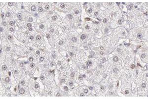 ABIN6266502 at 1/200 staining human liver carcinoma tissue sections by IHC-P. (Caspase 10 Antikörper)