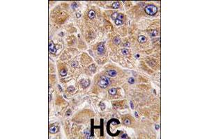 Formalin-fixed and paraffin-embedded human hepatocellular carcinoma reacted with ALDH5A1 polyclonal antibody  , which was peroxidase-conjugated to the secondary antibody, followed by DAB staining. (ALDH5A1 Antikörper  (C-Term))