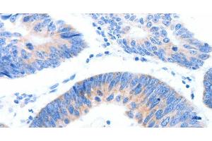 Immunohistochemistry of paraffin-embedded Human colon cancer tissue using MUC3A Polyclonal Antibody at dilution 1:60 (MUC3A Antikörper)