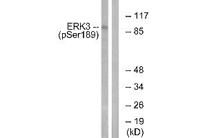Immunohistochemistry analysis of paraffin-embedded human breast carcinoma tissue using ERK3 (Phospho-Ser189) antibody. (MAPK6 Antikörper  (pSer189))