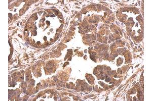IHC-P Image EIF4A2 antibody detects EIF4A2 protein at cytosol on human ovarian carcinoma by immunohistochemical analysis. (EIF4A2 Antikörper)