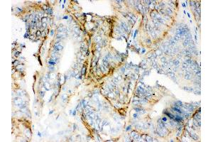 Anti-PKLR Picoband antibody, IHC(P) IHC(P): Human Intestinal Cancer Tissue (PKLR Antikörper  (C-Term))