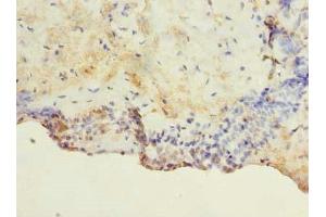 Immunohistochemistry of paraffin-embedded human breast cancer using ABIN7172926 at dilution of 1:100 (TM4SF1 Antikörper  (AA 115-161))