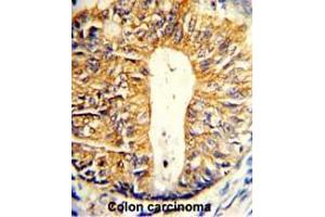 Formalin-fixed and paraffin-embedded human colon carcinoma reacted with Villin-1 Antibody (N-term), which was peroxidase-conjugated to the secondary antibody, followed by DAB staining. (Villin 1 Antikörper  (N-Term))