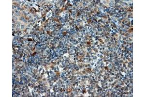 Immunohistochemical staining of paraffin-embedded Carcinoma of liver tissue using anti-LIPG mouse monoclonal antibody. (LIPG Antikörper)