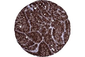 Acinar cell carcinoma of the pancreas exhibiting a strong CELA3B immunostaining of all tumor cells (Rekombinanter Elastase 3B Antikörper  (AA 82-238))