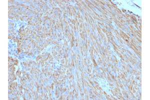Formalin-fixed, paraffin-embedded human GIST stained with CD117 Mouse Monoclonal Antibody (C117/370). (KIT Antikörper)