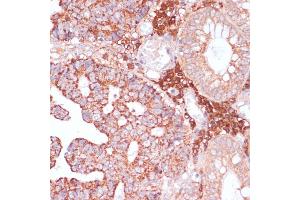 Immunohistochemistry of paraffin-embedded human colon carcinoma using MZB1 antibody (ABIN7268403) at dilution of 1:100 (40x lens).