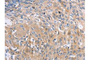 The image on the left is immunohistochemistry of paraffin-embedded Human cervical cancer tissue using ABIN7191576(NBEA Antibody) at dilution 1/60, on the right is treated with synthetic peptide. (Neurobeachin Antikörper)