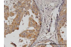 Immunoperoxidase of monoclonal antibody to ERBB2 on formalin-fixed paraffin-embedded human breast cancer. (ErbB2/Her2 Antikörper  (AA 22-121))