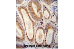 WFDC12 antibody (C-term) (ABIN654327 and ABIN2844104) immunohistochemistry analysis in formalin fixed and paraffin embedded human prostate carcinoma followed by peroxidase conjugation of the secondary antibody and DAB staining. (WFDC12 Antikörper  (C-Term))