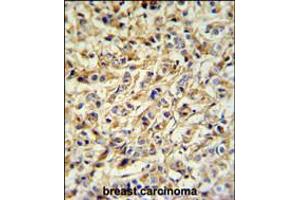 PRELP Antibody IHC analysis in formalin fixed and paraffin embedded breast carcinoma followed by peroxidase conjugation of the secondary antibody and DAB staining. (PRELP Antikörper  (AA 119-148))