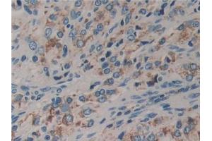 IHC-P analysis of Human Prostate cancer Tissue, with DAB staining. (DVL2 Antikörper  (AA 78-250))