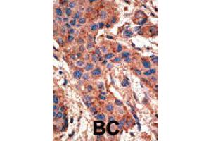 Formalin-fixed and paraffin-embedded human cancer tissue reacted with BMPR1A polyclonal antibody  , which was peroxidase-conjugated to the secondary antibody, followed by AEC staining. (BMPR1A Antikörper  (AA 39-69))