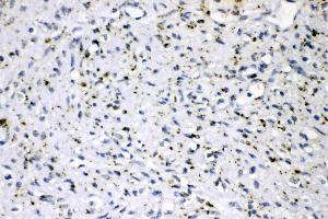 ADFP was detected in paraffin-embedded sections of human mammary cancer tissues using rabbit anti- ADFP Antigen Affinity purified polyclonal antibody (Catalog # ) at 1 µg/mL. (ADRP Antikörper  (AA 226-418))