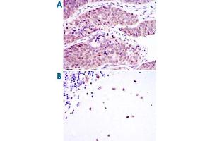 Immunohistochemical analysis of paraffin-embedded human ovarian cancer (A) and cerebellum tissues (B) using MSI2 monoclonal antibody, clone 2C11  with DAB staining.
