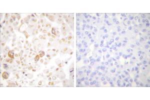 Peptide - +Immunohistochemical analysis of paraffin-embedded human breast carcinoma tissue using Cyclin F antibody (#C0168). (Cyclin F Antikörper)