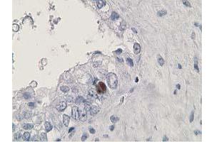 Immunohistochemical staining of paraffin-embedded Adenocarcinoma of Human ovary tissue using anti-HDHD2 mouse monoclonal antibody. (HDHD2 Antikörper)