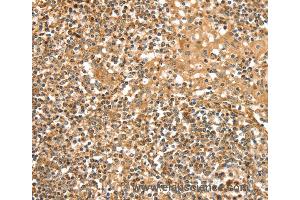 Immunohistochemistry of Human cervical cancer using SLC8A3 Polyclonal Antibody at dilution of 1:35