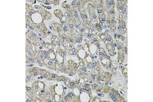 Immunohistochemistry of paraffin-embedded human liver injury using GFPT1 antibody. (GFPT1 Antikörper)