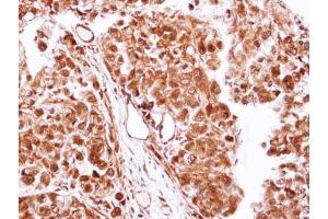 IHC-P Image Immunohistochemical analysis of paraffin-embedded CL1-0 xenograft, using Casein Kinase 2 beta, antibody at 1:100 dilution. (CSNK2B Antikörper)