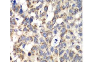 Immunohistochemistry of paraffin-embedded Human esophageal cancer using PARN Polyclonal Antibody at dilution of 1:100 (40x lens). (PARN Antikörper)