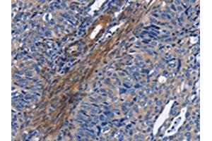 The image on the left is immunohistochemistry of paraffin-embedded Human cervical cancer tissue using ABIN7130344(NAT8 Antibody) at dilution 1/50, on the right is treated with fusion protein. (NAT8 Antikörper)