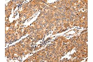 The image on the left is immunohistochemistry of paraffin-embedded Human prostate cancer tissue using ABIN7130145(MAP2 Antibody) at dilution 1/20, on the right is treated with fusion protein. (MAP2 Antikörper)