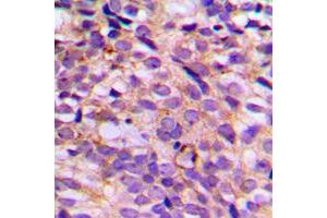 Immunohistochemical analysis of SGK223 (pY413) staining in human breast cancer formalin fixed paraffin embedded tissue section. (PRAGMIN Antikörper  (pTyr413))