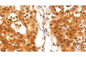 Immunohistochemistry of paraffin-embedded Human lung cancer using SERPINB5 Polyclonal Antibody at dilution of 1:60 (SERPINB5 Antikörper)