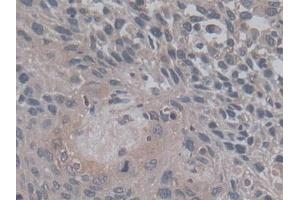 DAB staining on IHC-P; Samples: Human Lung cancer Tissue) (TGFB3 Antikörper  (AA 24-300))