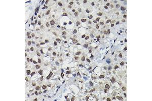 Immunohistochemistry of paraffin-embedded human breast cancer using Cyclin K Rabbit pAb (ABIN6128996, ABIN6138098, ABIN6138099 and ABIN6214445) at dilution of 1:100 (40x lens). (Cyclin K Antikörper  (AA 1-160))