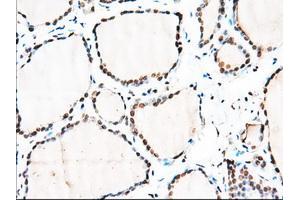 Immunohistochemical staining of paraffin-embedded Adenocarcinoma of Human colon tissue using anti-MTRF1L mouse monoclonal antibody. (MTRF1L Antikörper)