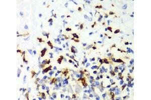 Immunohistochemistry of paraffin-embedded Human liver cancer using CAPG Polyclonal Antibody at dilution of 1:100 (40x lens). (CAPG Antikörper)