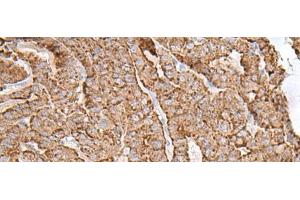 Immunohistochemistry of paraffin-embedded Human thyroid cancer tissue using AP1S1 Polyclonal Antibody at dilution of 1:65(x200) (AP1S1 Antikörper)