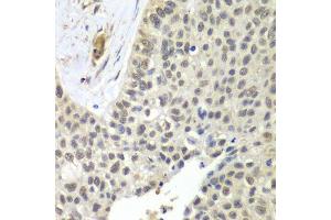 Immunohistochemistry of paraffin-embedded human lung cancer using SNRPD2 antibody. (SNRPD2 Antikörper  (AA 1-118))